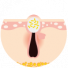 Papule Papule